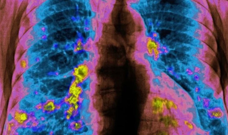 Akciğer Kanserinde Yeni İlaç Osimertinib, Ölüm Riskini Yarıya İndirebilir